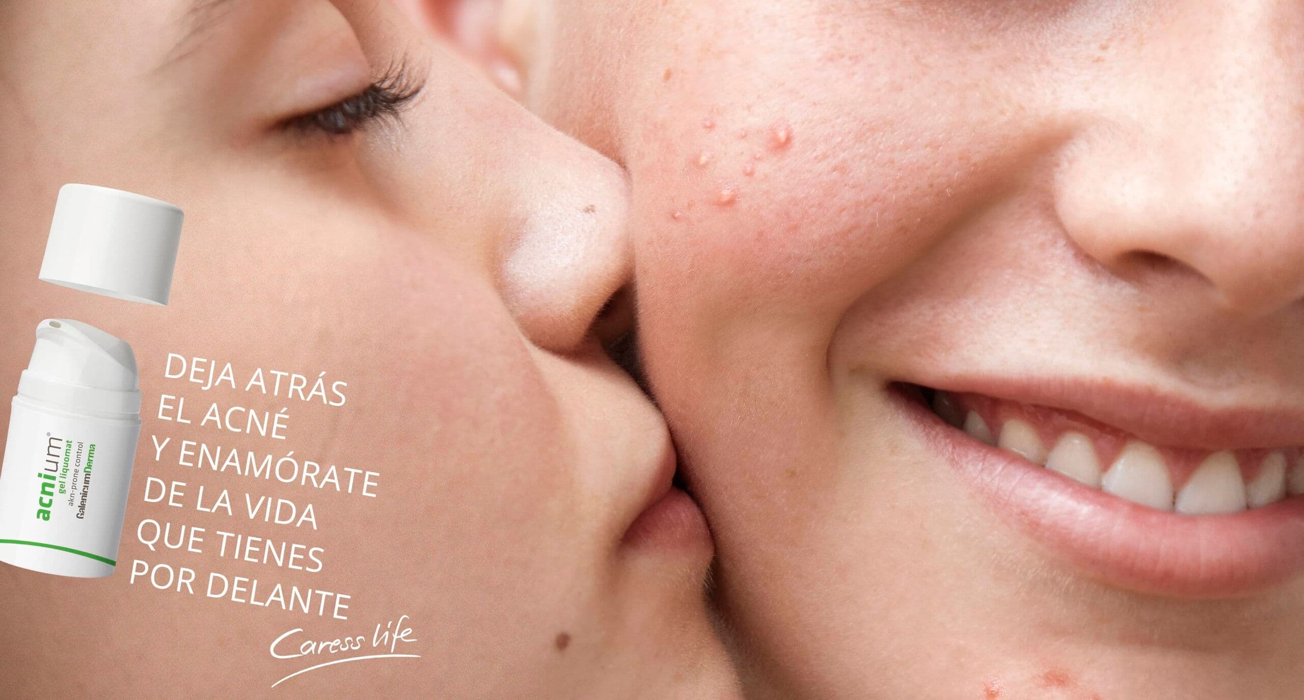 Anuncio acne